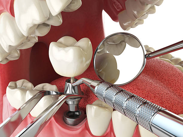 Best Knocked-Out Tooth Emergency  in Crocker, WA